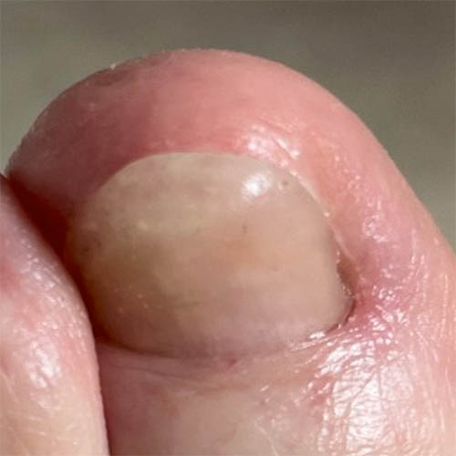 Prothèse d'ongle onychoplastie